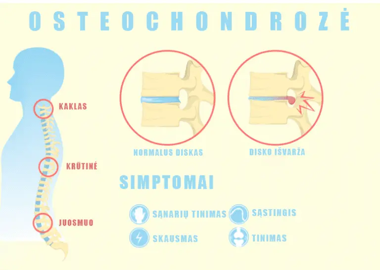 Osteochondrozes Kinezoterapija