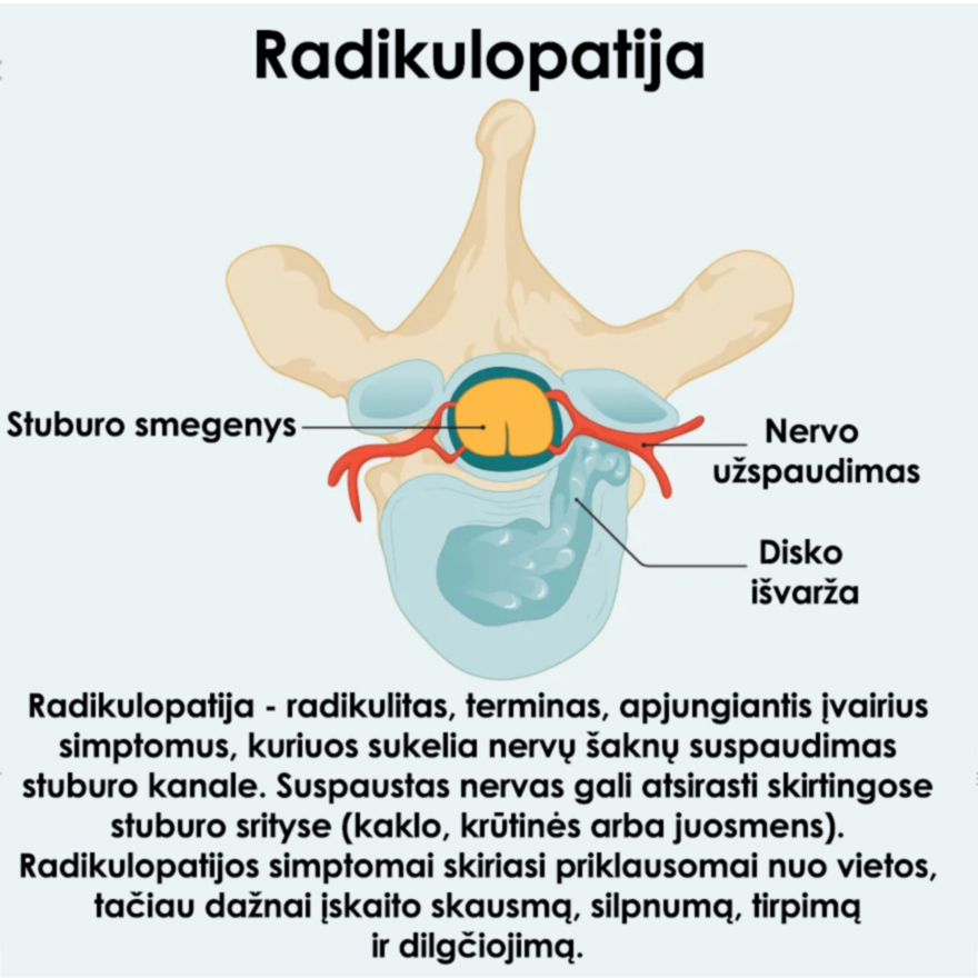 Radikulopatija-Radikulitas